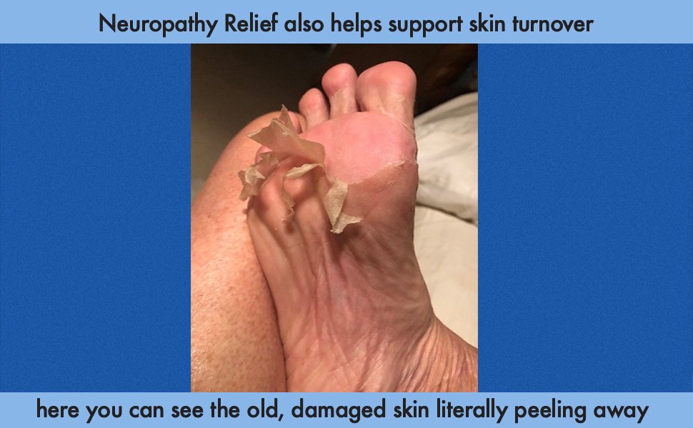 photo of dead skin peeling away