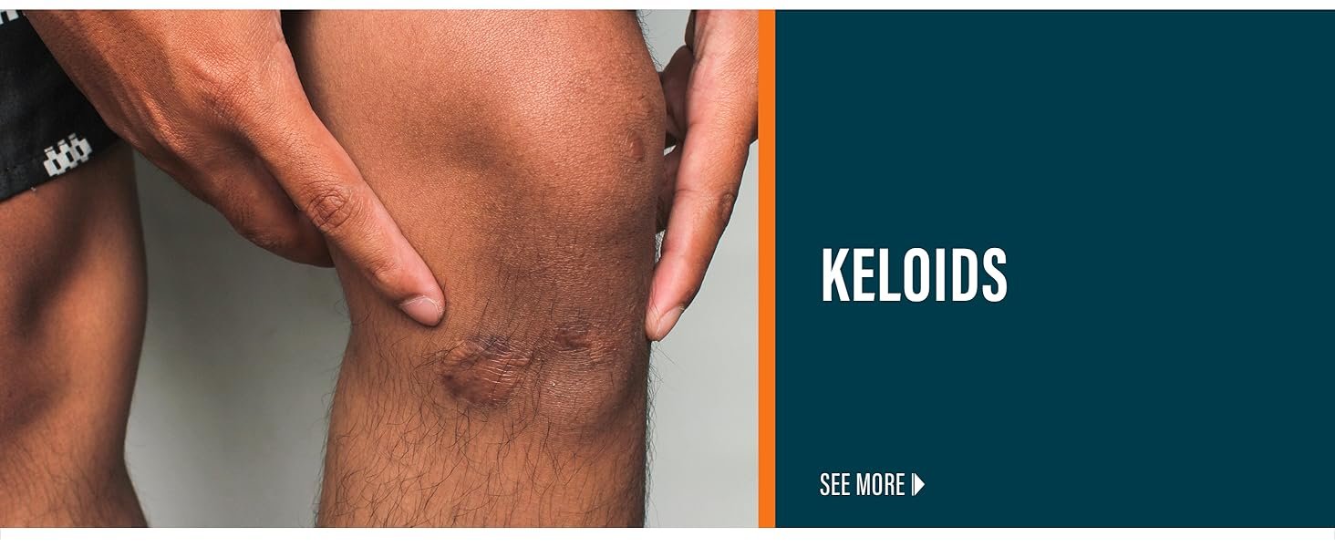 Keloids