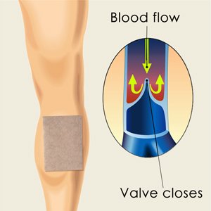 Varicose Veins Patch